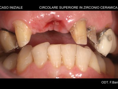 Caso 12 “corona in zirconio”
