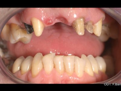 Caso 12 “corona in zirconio”