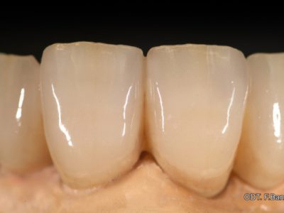 Caso 12 “corona in zirconio”