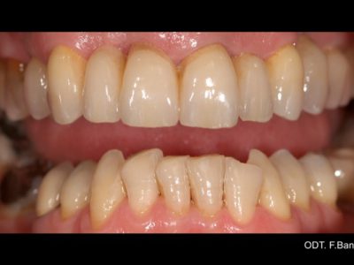 Caso 12 “corona in zirconio”