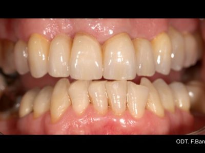 Caso 12 “corona in zirconio”
