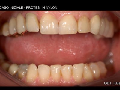 Caso 15 “Protesi in nylon”