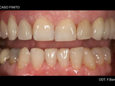 Caso 15 “Protesi in nylon”