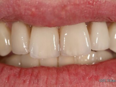 Caso 1 “faccette in ceramica”