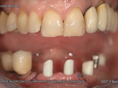 Caso 2 “ponte in zirconio ceramica su impianti”