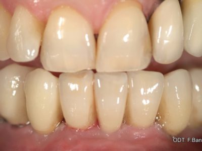 Caso 2 “ponte in zirconio ceramica su impianti”