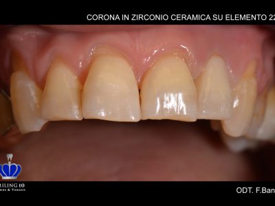 Caso 19 “Corona in zirconio ceramica”