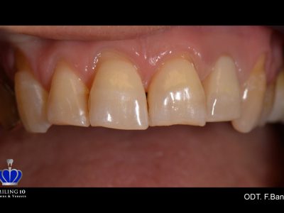 Caso 19 “Corona in zirconio ceramica”