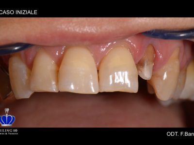 Caso 19 “Corona in zirconio ceramica”